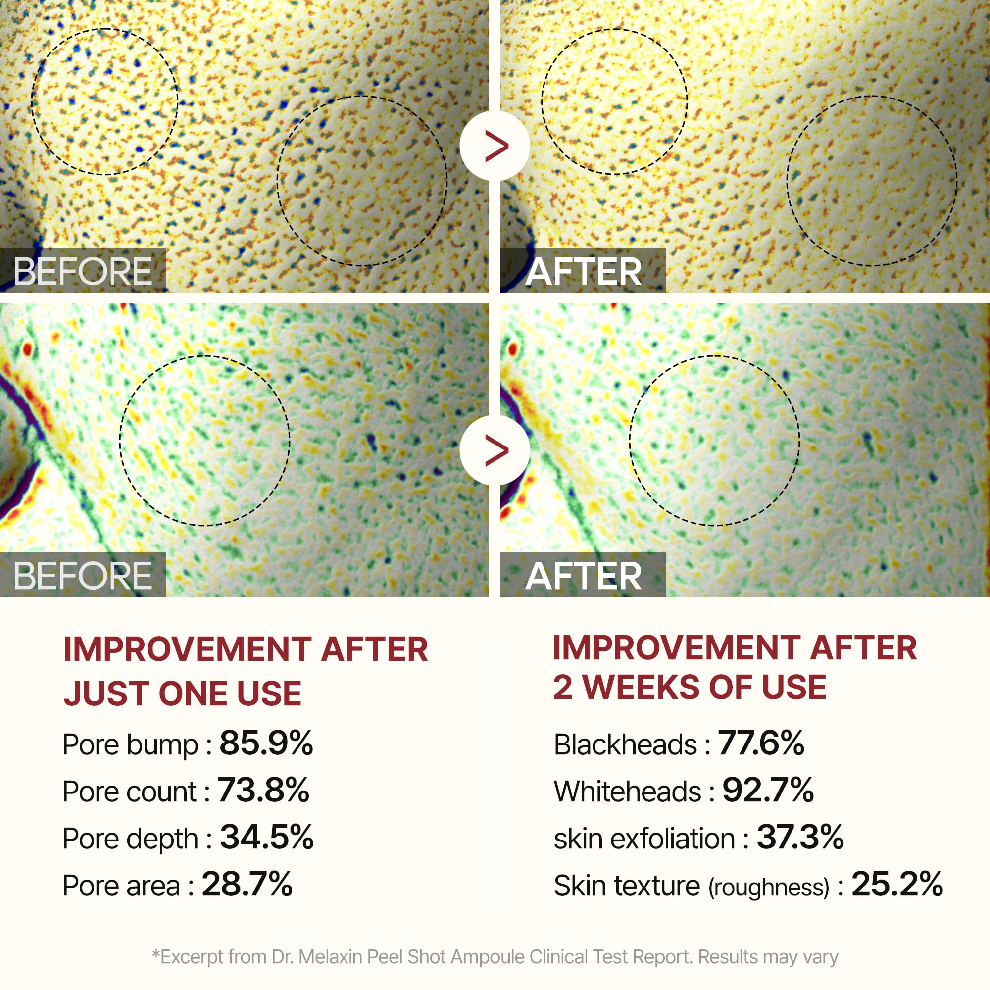 Dr.Melaxin Peel Shot Glow before and after glimpse at clearer pores