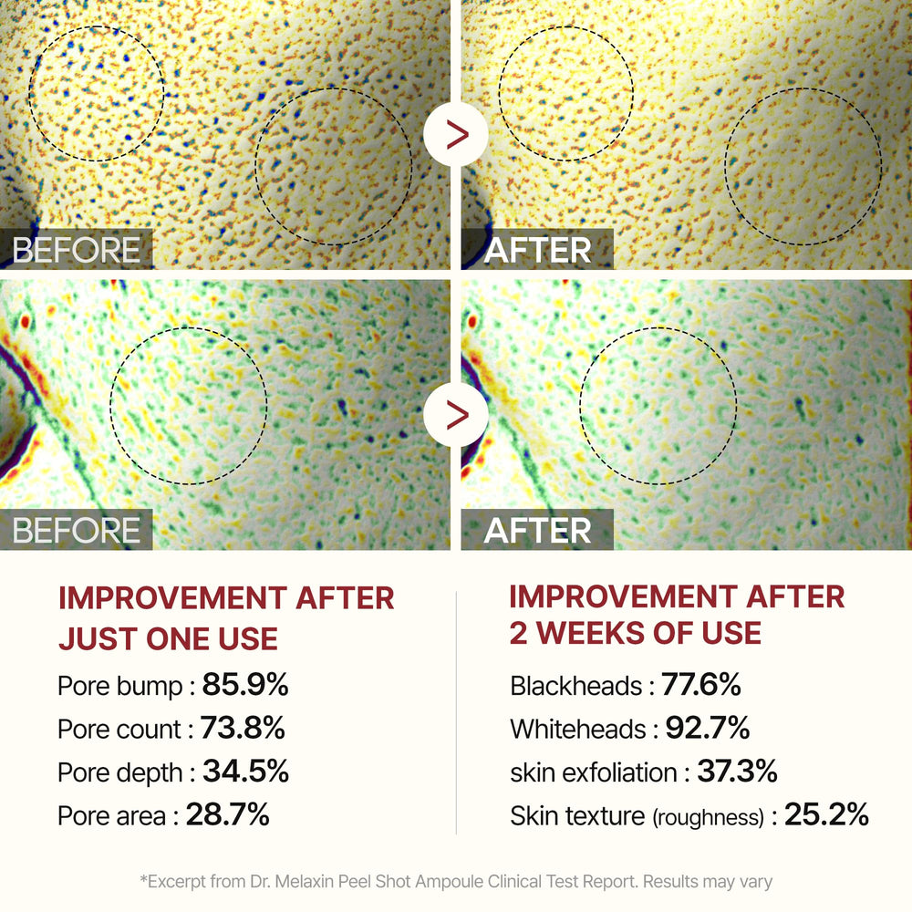 Dr.Melaxin Peel Shot Glow before and after glimpse at clearer pores