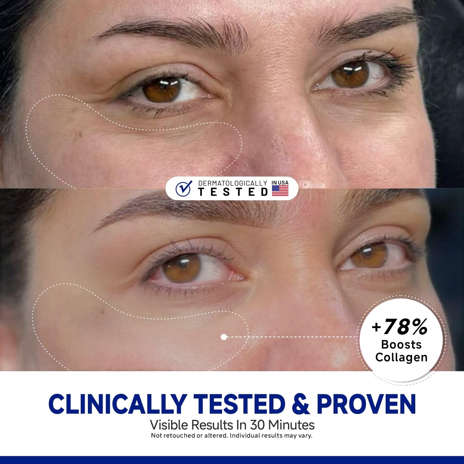 Dr Vincent peptide under-eye patches applied to skin for refreshing, rejuvenating effect.