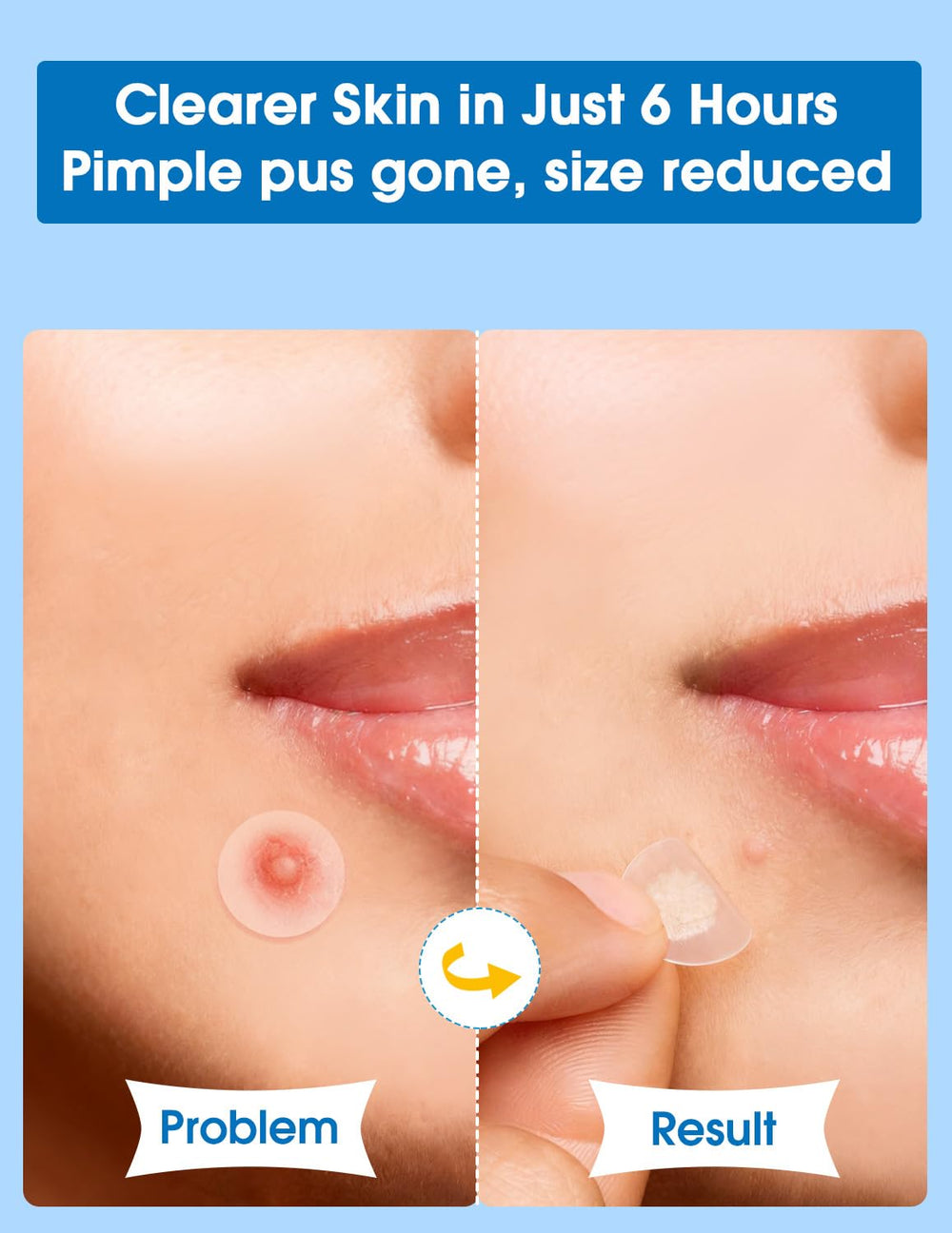 Dr. Zitacne patch 10mm ideal for larger blemishes with absorbed fluid