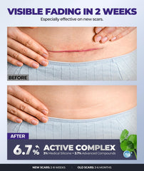 EASEWAVE scar cream gel texture demonstrates smooth, non-greasy application.