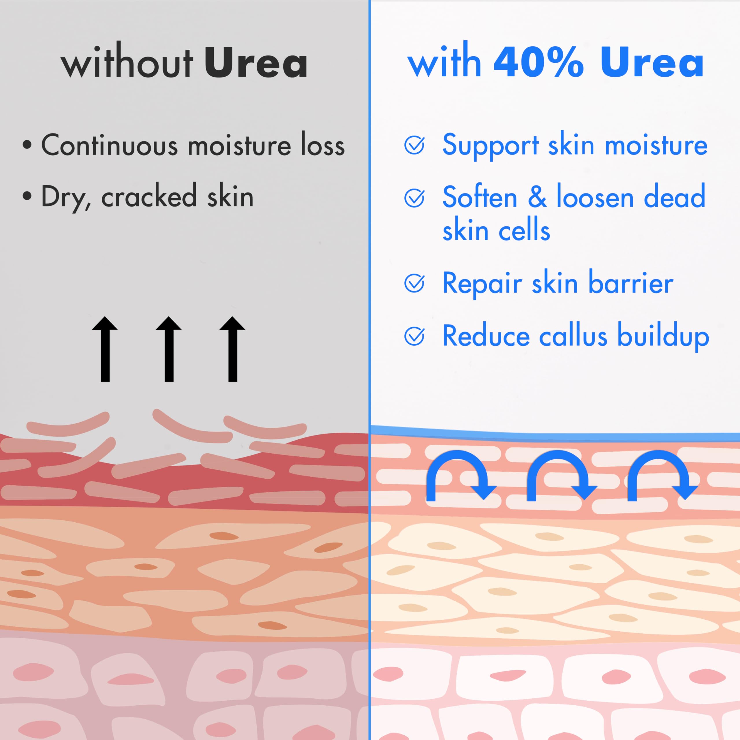 Keratolytic action helps soften nails and calluses with Ebanel cream.