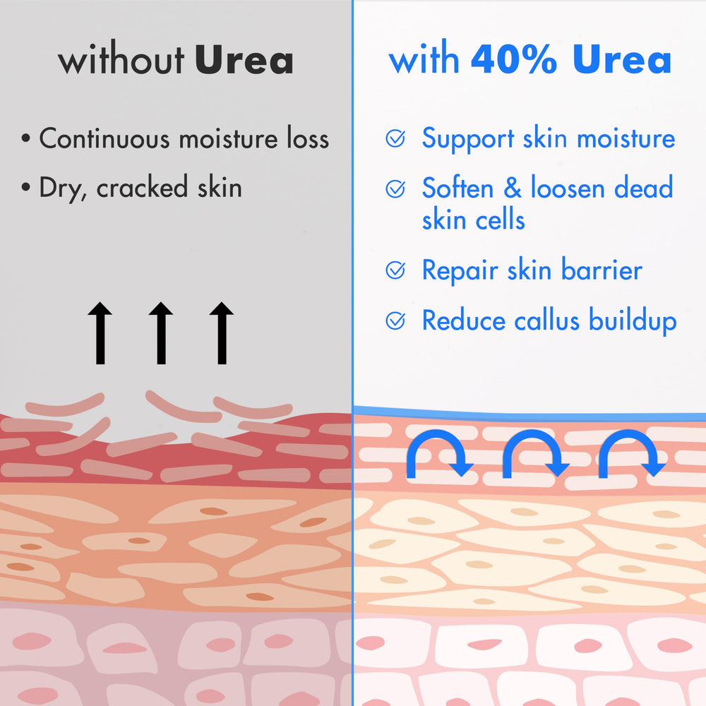 Ebanel Urea 40% foot nail softener in use.