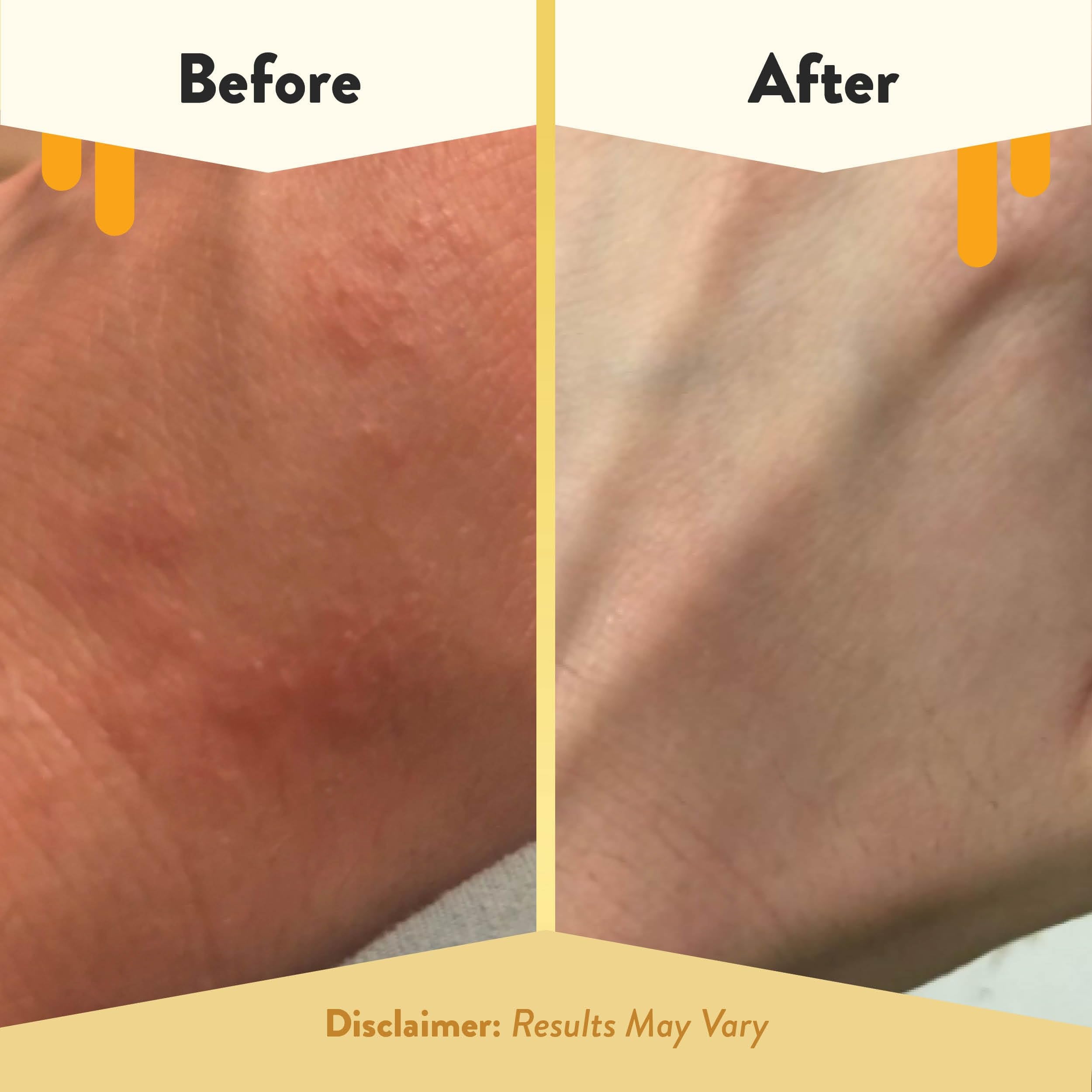 Hands applying ECZEMA HONEY Oatmeal Body Lotion for dry skin comfort.