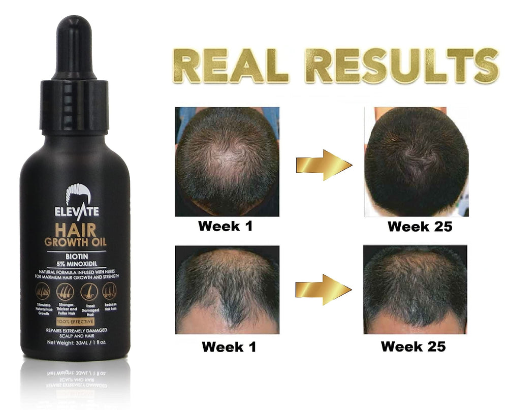 Elevate Minoxidil dropper image shows easy daily use for thinning areas.
