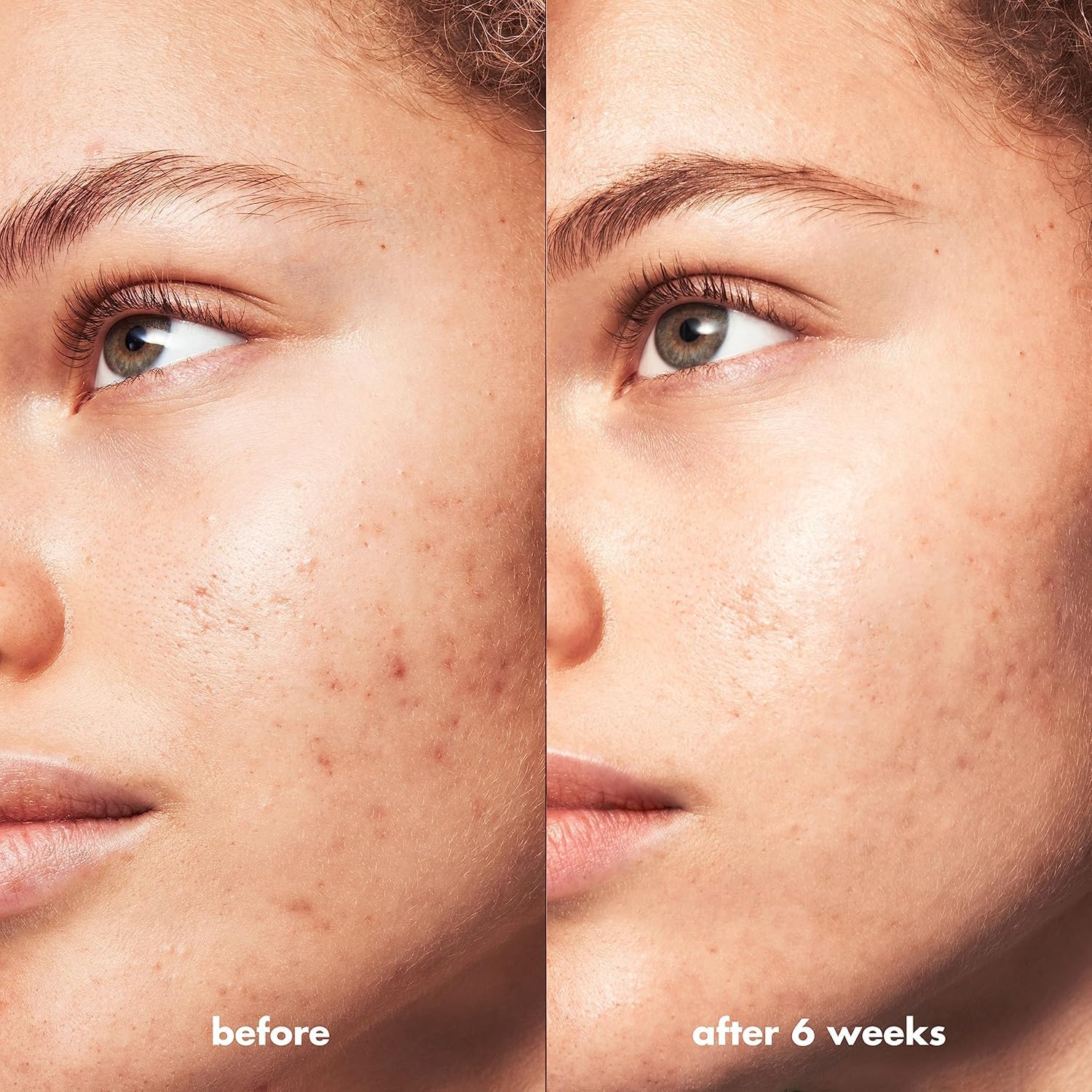 e.l.f. SKIN Blemish Breakthrough cleanser in a morning routine setup beside towels and water.