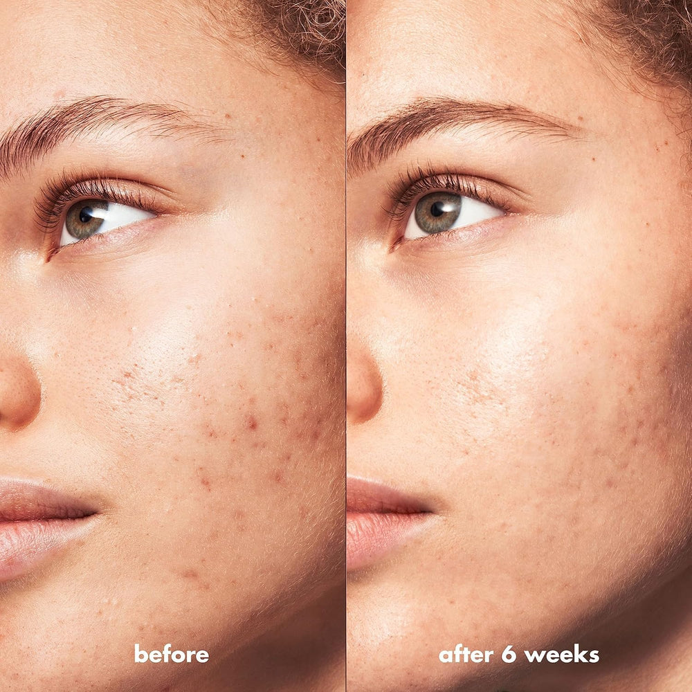 e.l.f. SKIN Blemish Breakthrough shows improved skin tone close-up