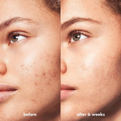 e.l.f. SKIN Blemish Breakthrough shows improved skin tone close-up