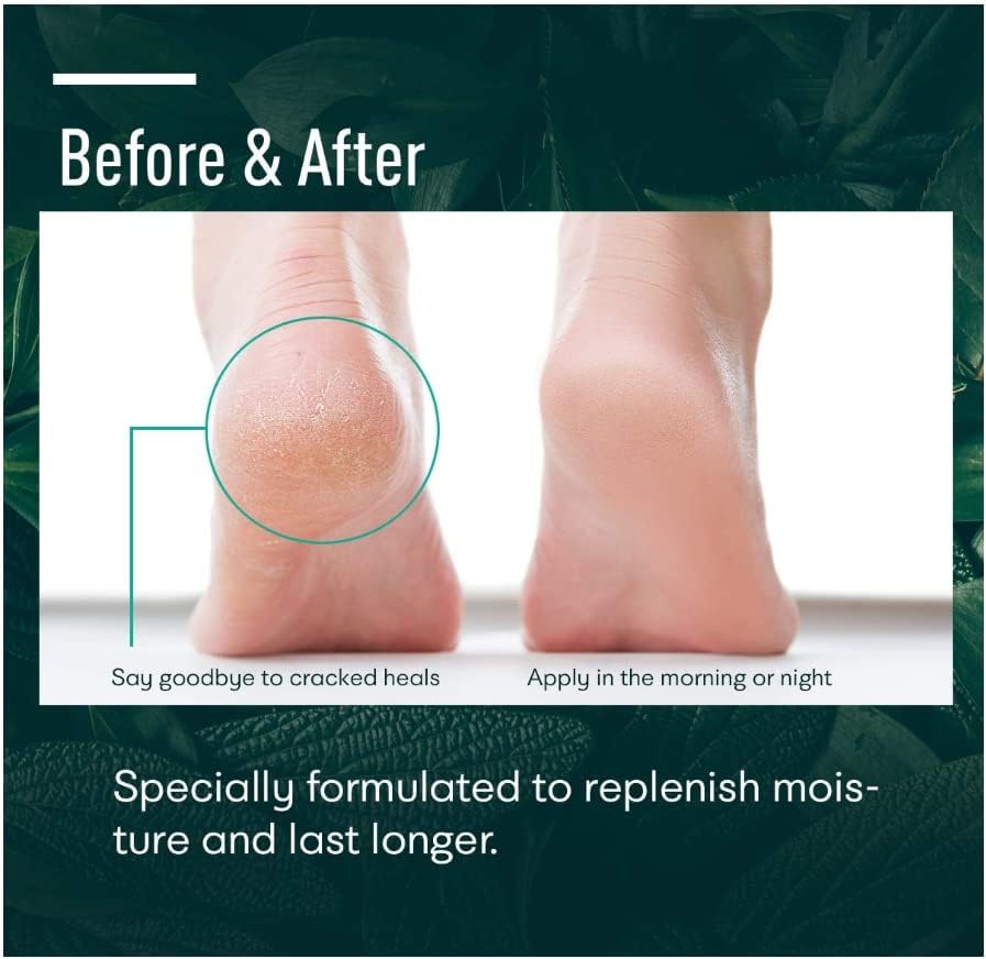 Application shot of Ellocy Urea 40% cream spread on a dry heel