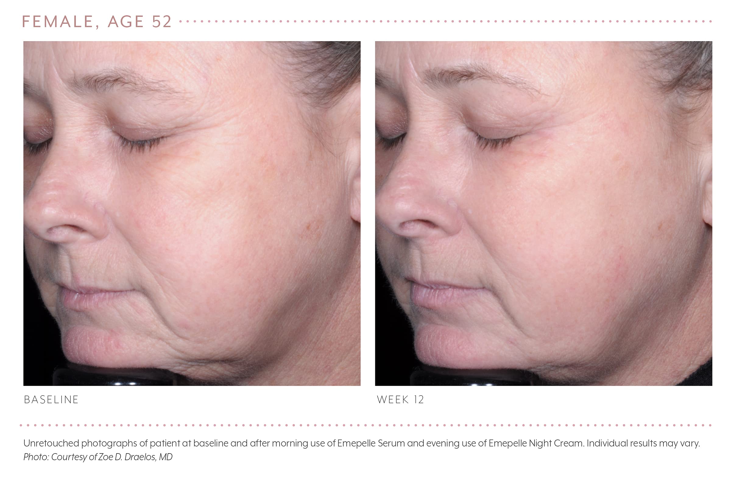 Emepelle serum featured in a night skincare routine