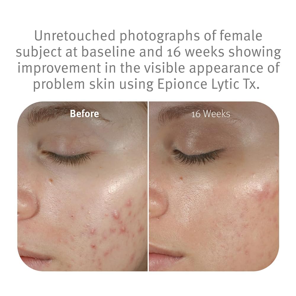 Epionce Lytic Tx contains salicylic acid to help clarify pores.