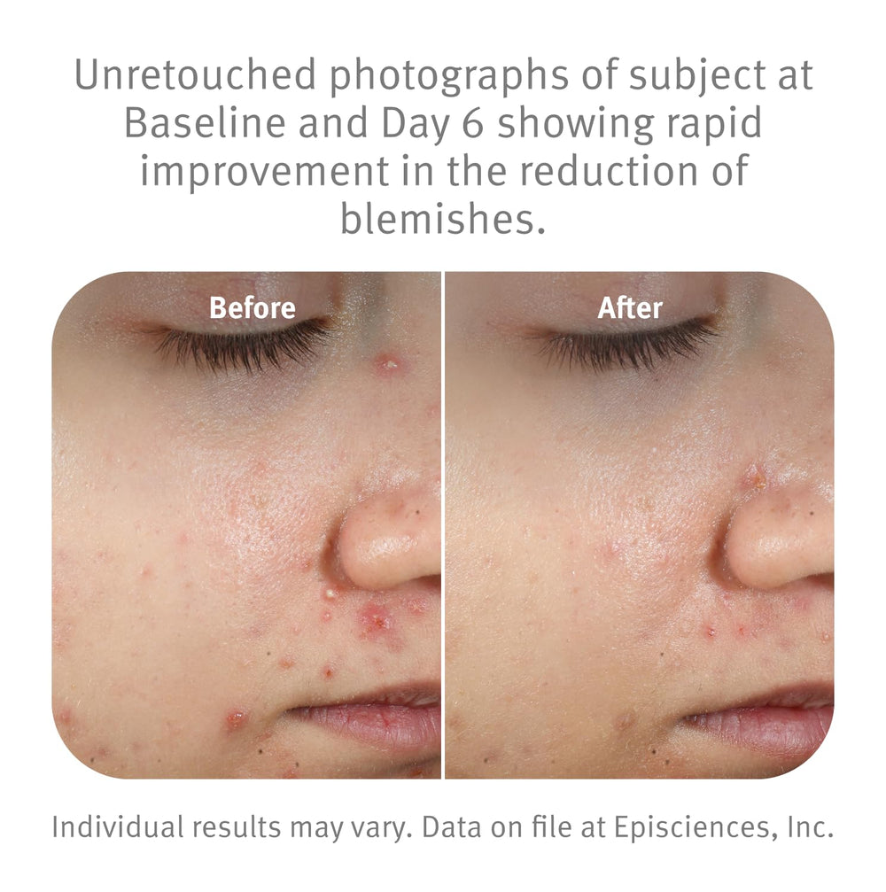 Epionce spot gel close-up shows rapid action against stubborn blemishes.