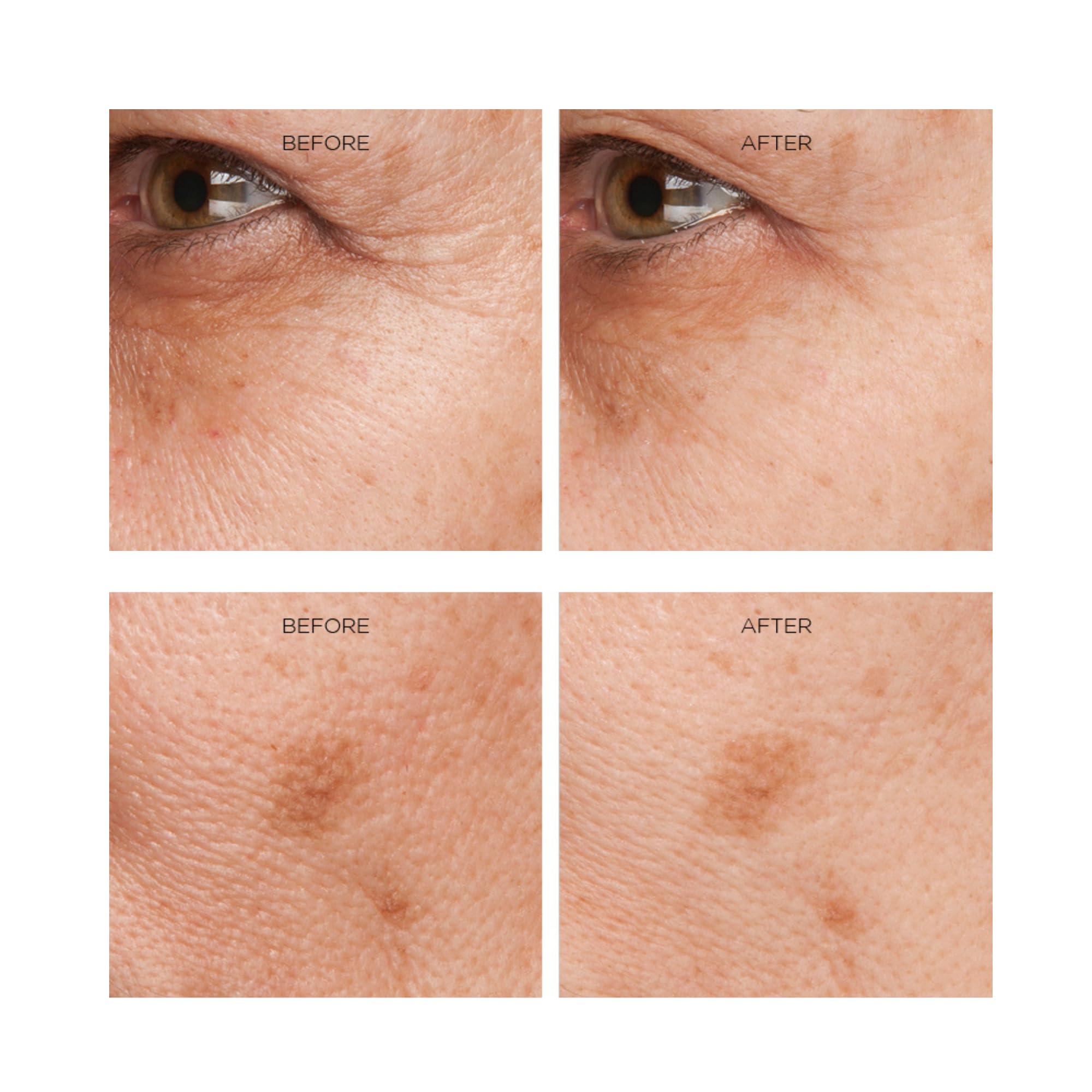 Before-after concept suggesting potential wrinkle-relaxing results with Erasa XEP 30