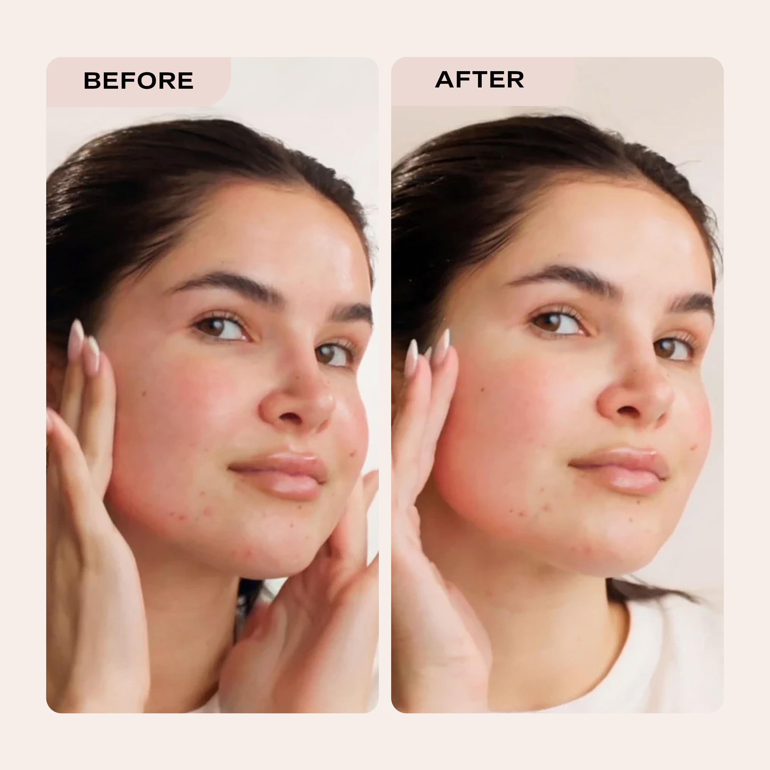 Post-peel skin looks smoother with a clarified, radiant tone.