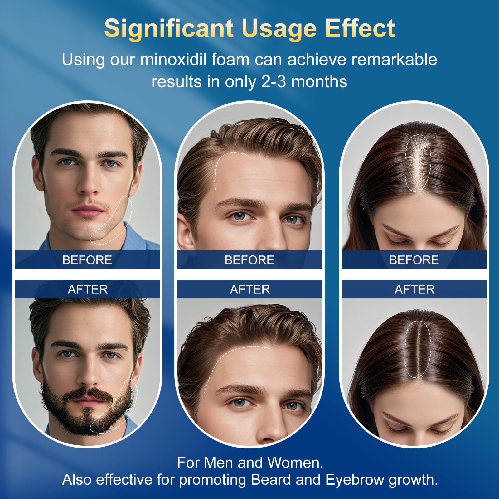 Exdeploy minoxidil foam with biotin label highlighting nutrient support