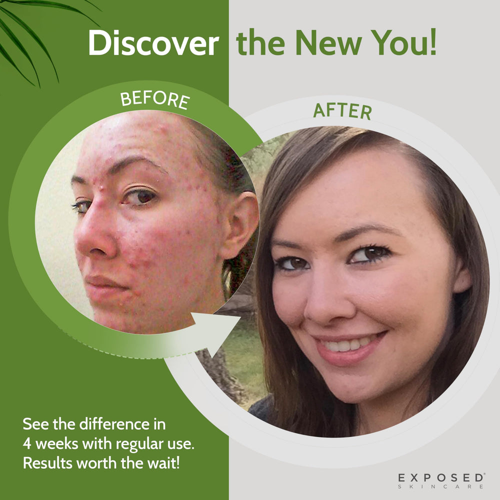 Exposed Skin Care acne cleanser with sage extract providing soothing properties.
