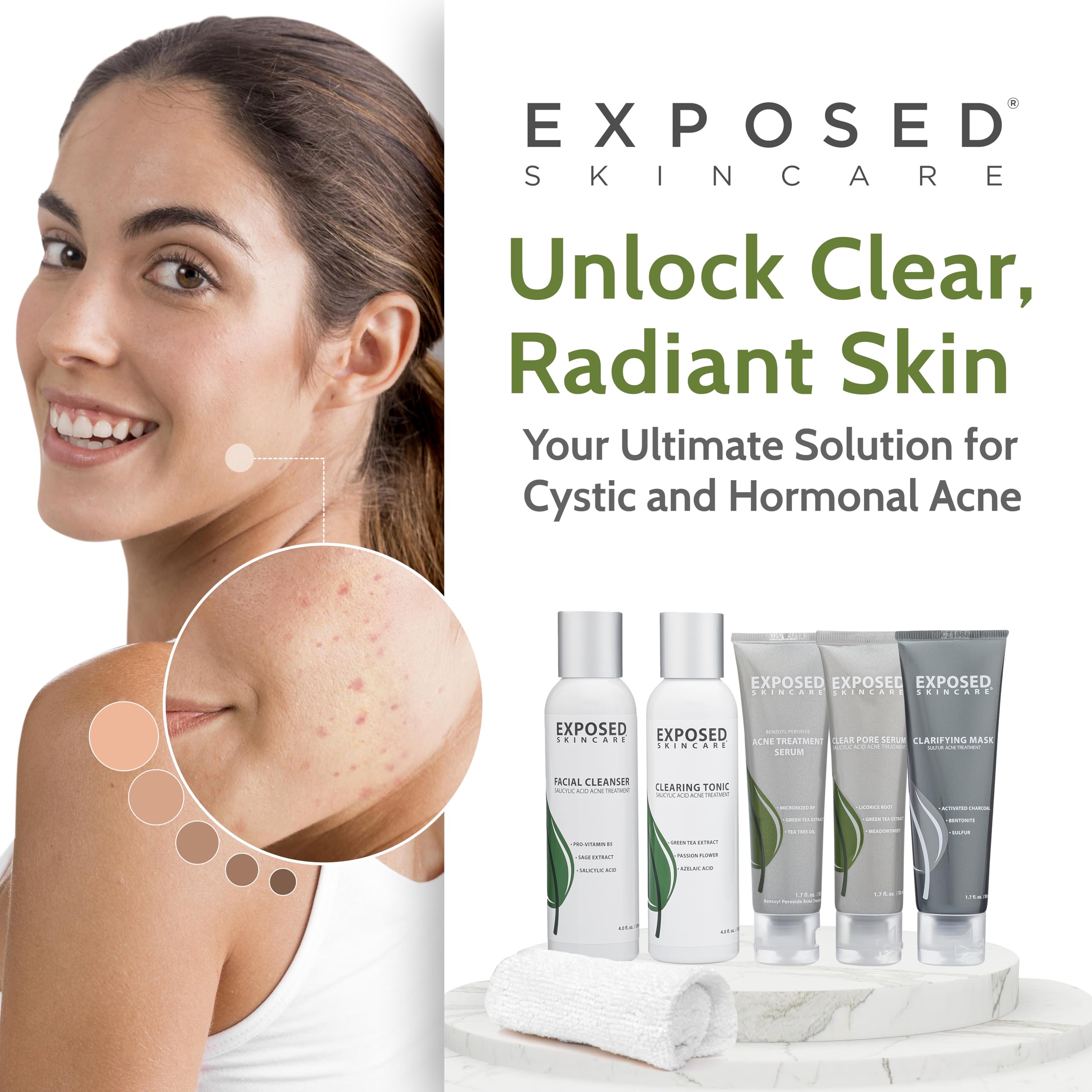 Exposed Skin Care acne kit routine setup for a two-month supply