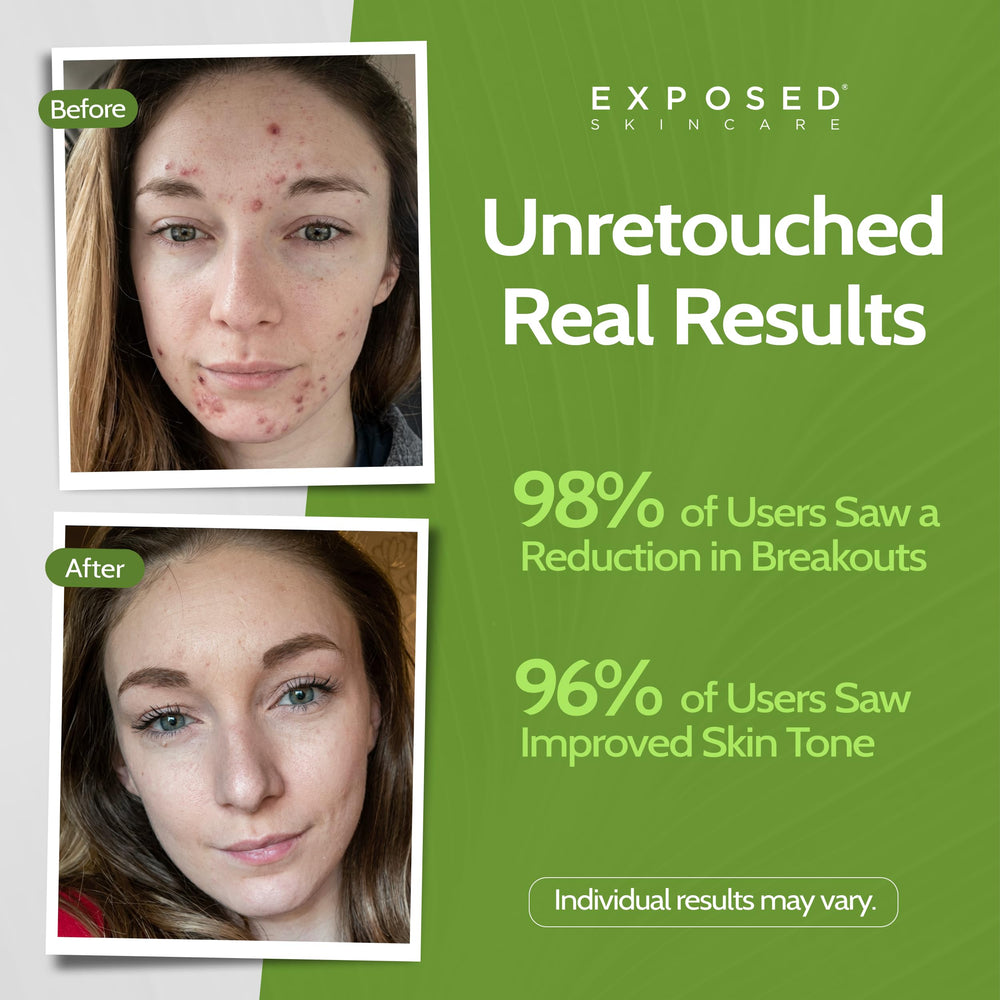 Exposed Skin Care Moisture Complex gel texture close-up highlights oil-free hydration
