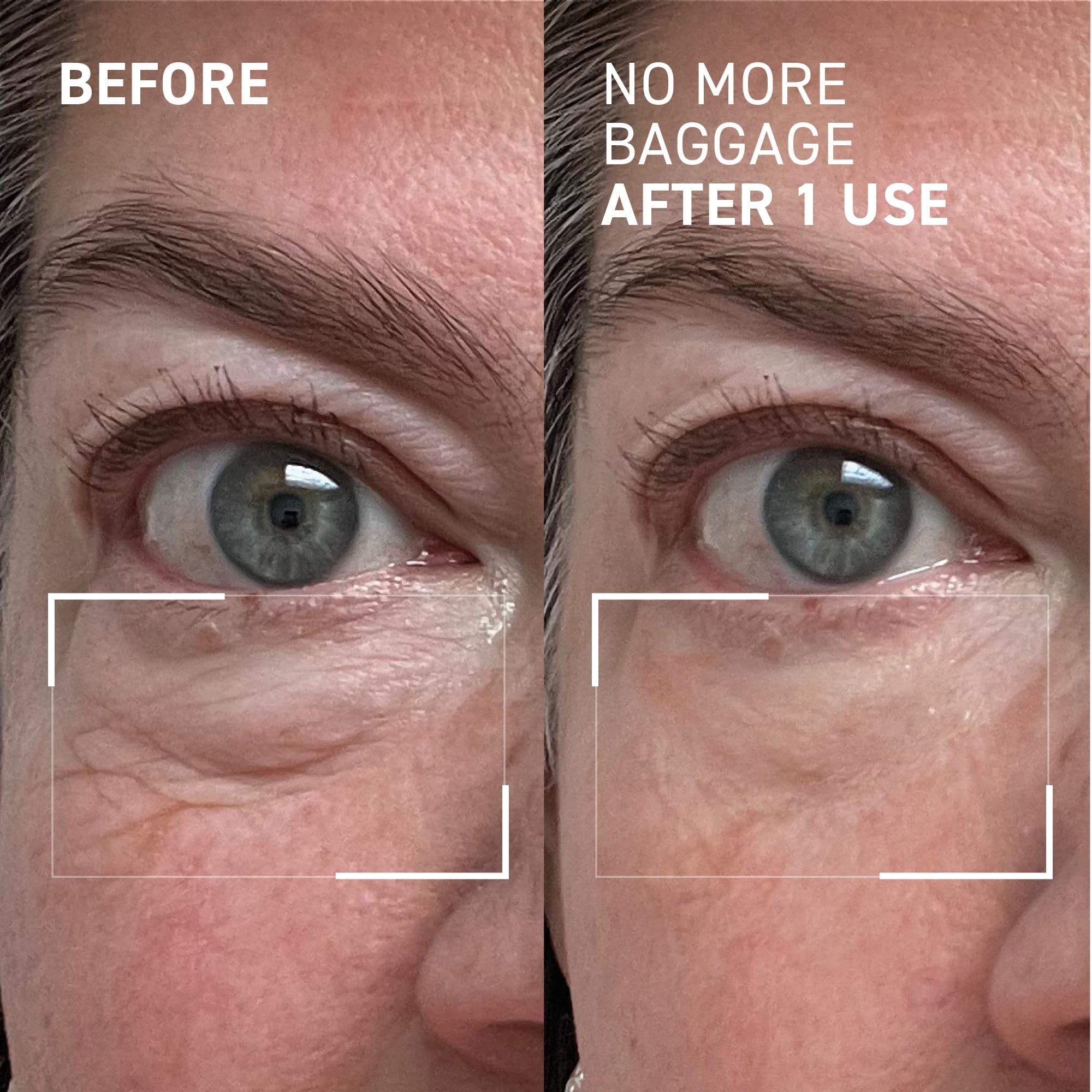 Applying Dr. Brandt Needles No More to the eye area