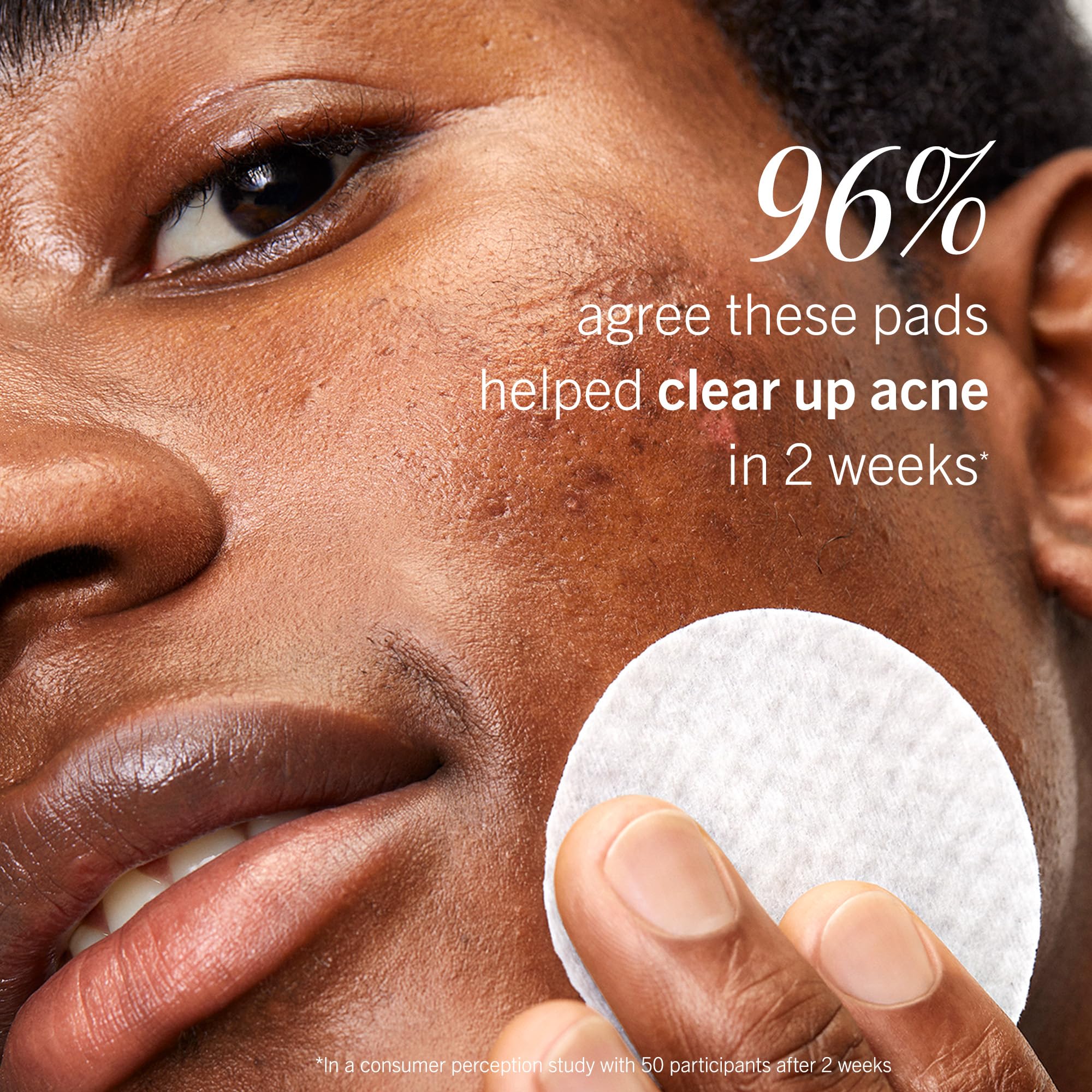 First Aid Beauty Acne Pads being used on acne-prone cheeks after cleansing.