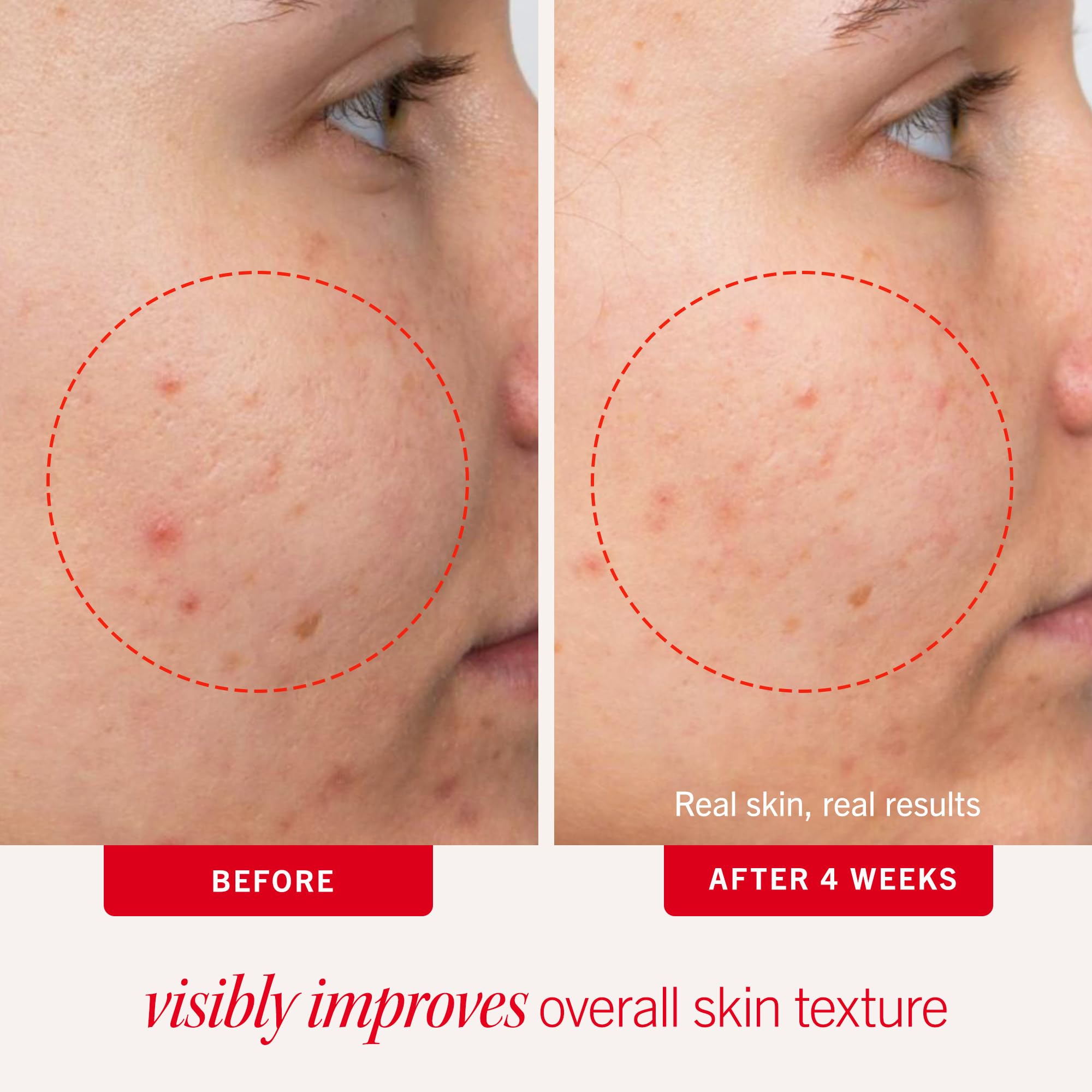 First Aid Beauty Acne Pads dual-sided pad ready to swipe over blemishes.