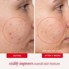 First Aid Beauty Acne Pads dual-sided pad ready to swipe over blemishes.