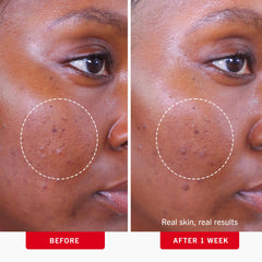 First Aid Beauty Acne Pads 2% Salicylic Acid formula close-up for active blemish treatment.