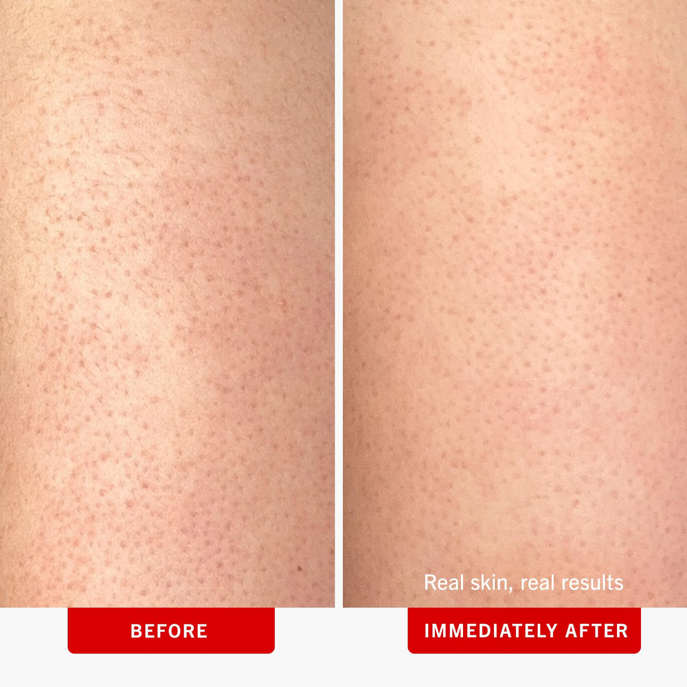 First Aid Beauty KP Bump Eraser arm application demonstrates gentle exfoliation.