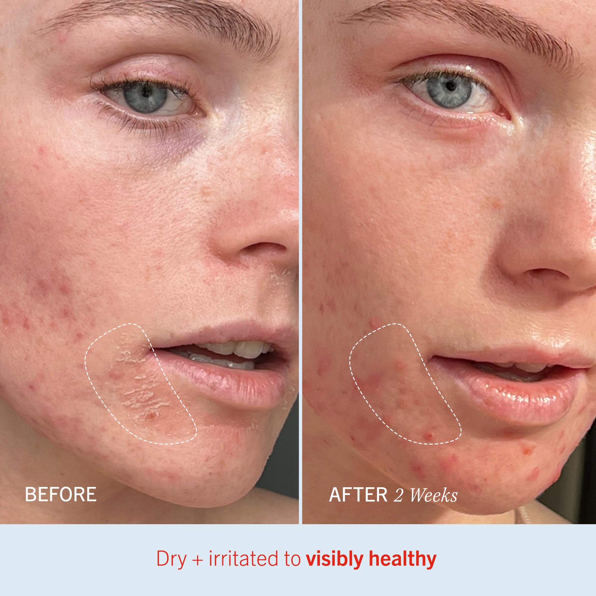 Application closeup of Ultra Repair Cream showing skin-friendly nourishment