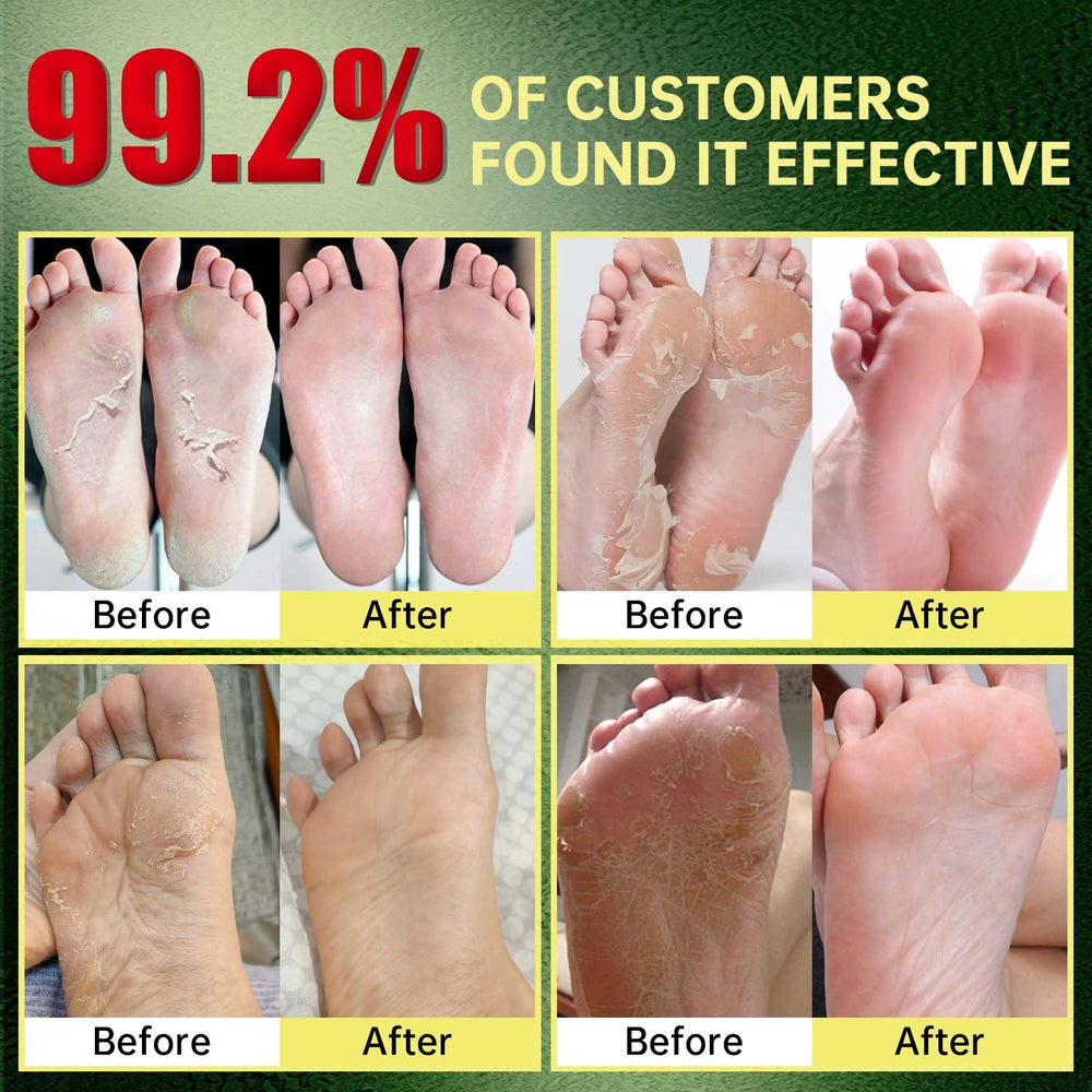 FLYLEAF Foot Peeling Mask being worn for 45–60 minutes promotes gentle renewal.