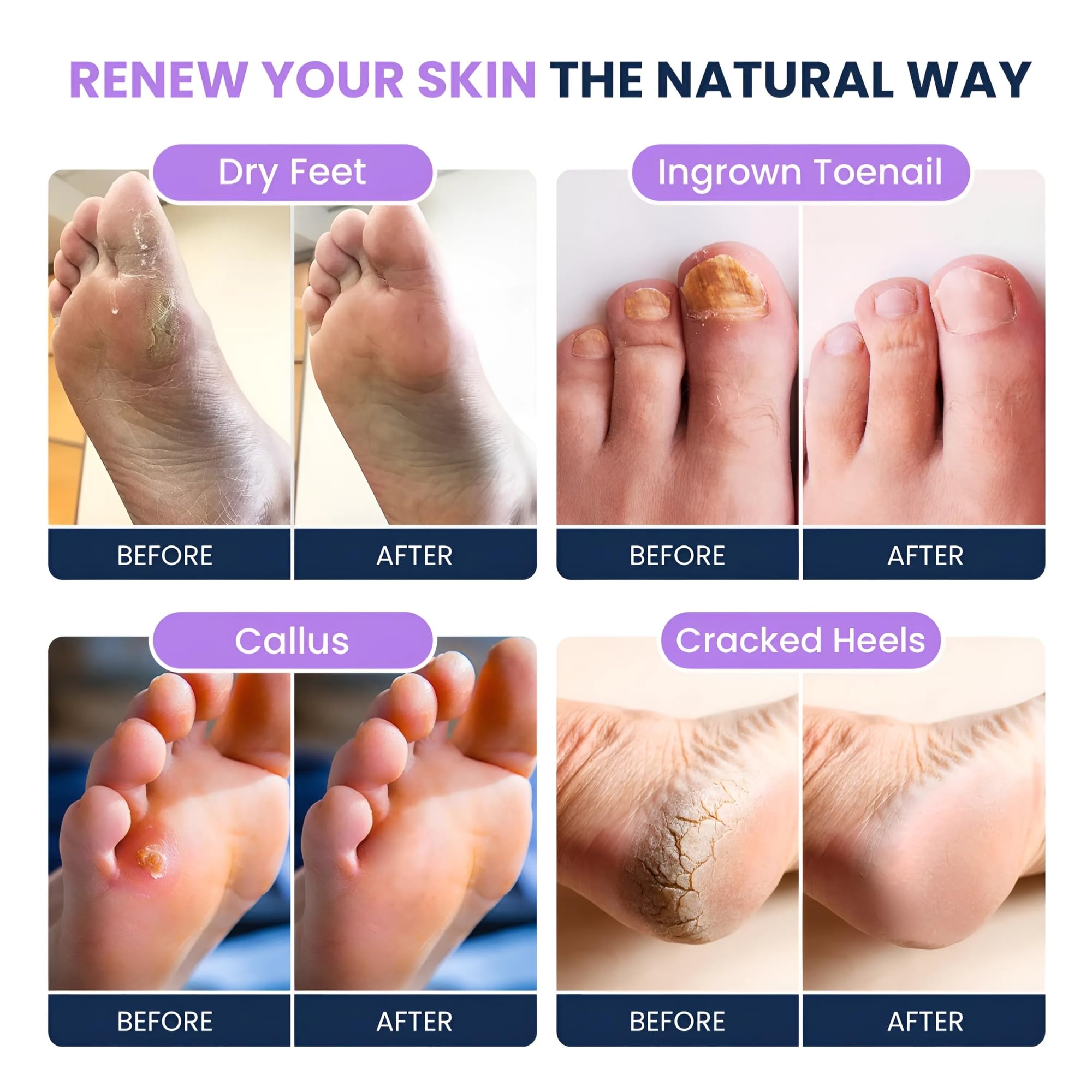 FOOT CURE pack four foot soak box offers easy storage and value.