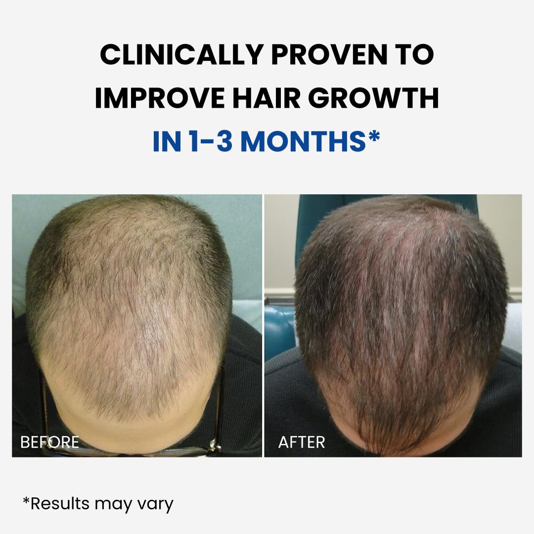 Close-up of ForHair spray being applied to the scalp for targeted growth.