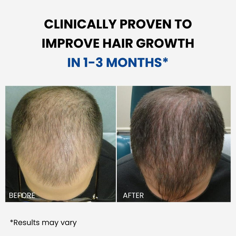 Close-up of ForHair spray being applied to the scalp for targeted growth.