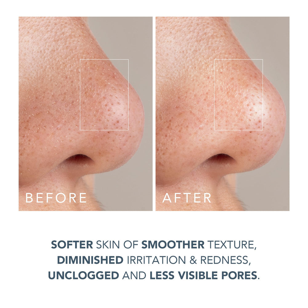 FOREO KIWI facial treatment session reveals refined texture and radiance