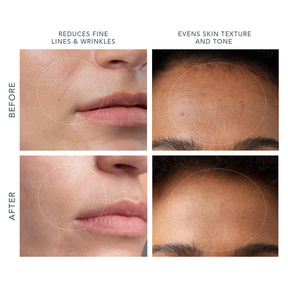 FOREO KIWI six suction intensities personalize pore extraction.