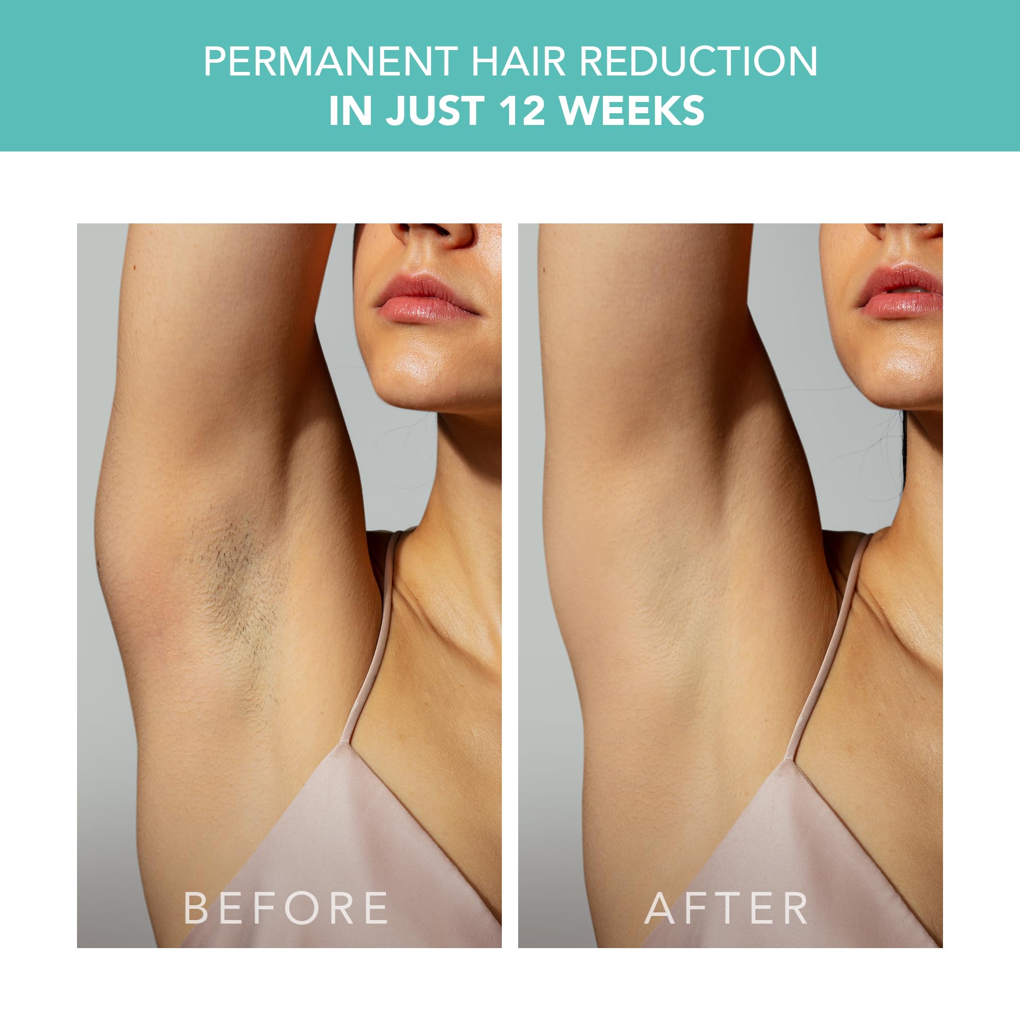 FOREO Peach 2 Skin Cooling System cools treated skin during IPL.