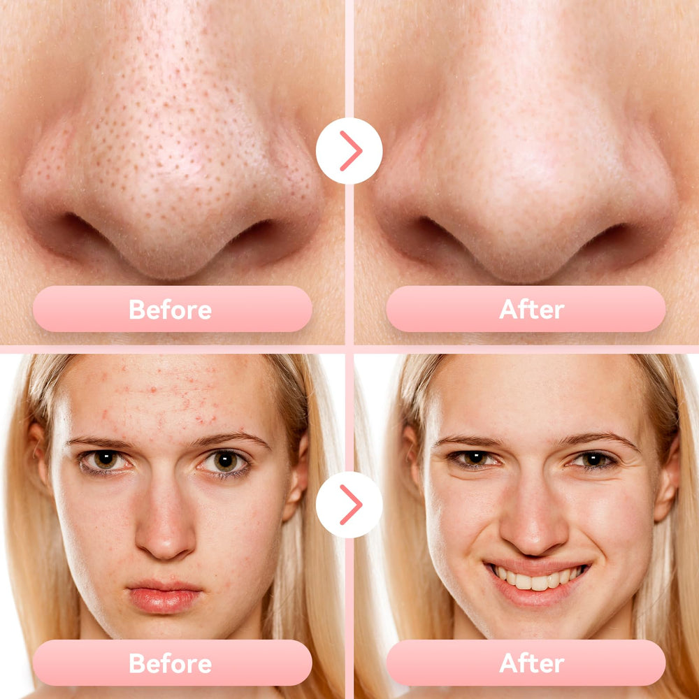 FREESHOW Vacuum in use on face demonstrates real-time suction action.