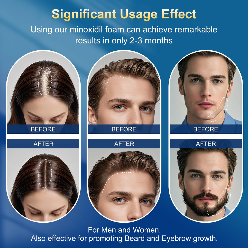 Frnoip minoxidil-foam bottle with screw cap enables clean, mess-free dispensing.