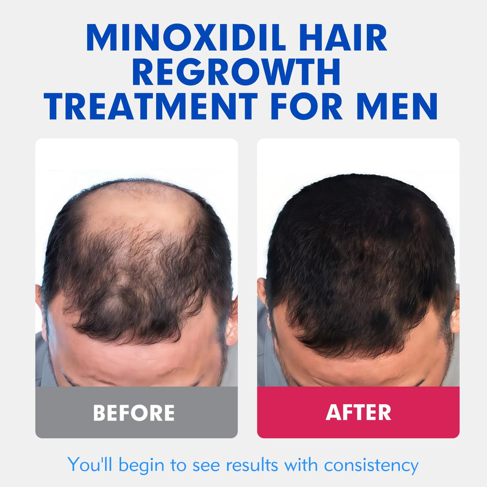 Fyntikal non greasy minoxidil fast absorbing on skin