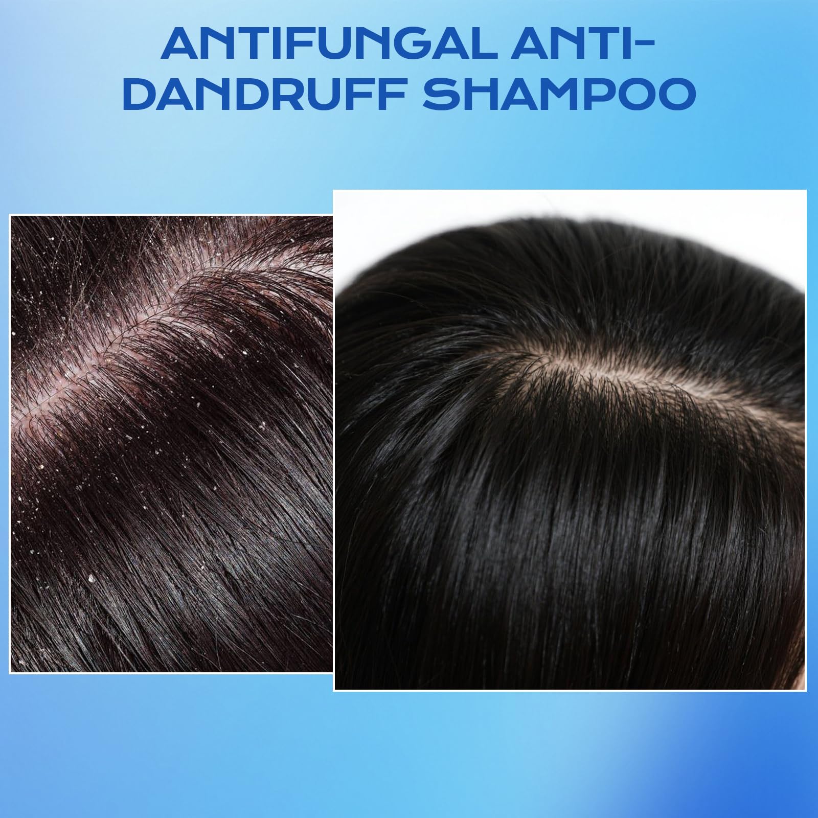 FYZMTL antifungal formula closeup highlights active ingredients and scalp relief.