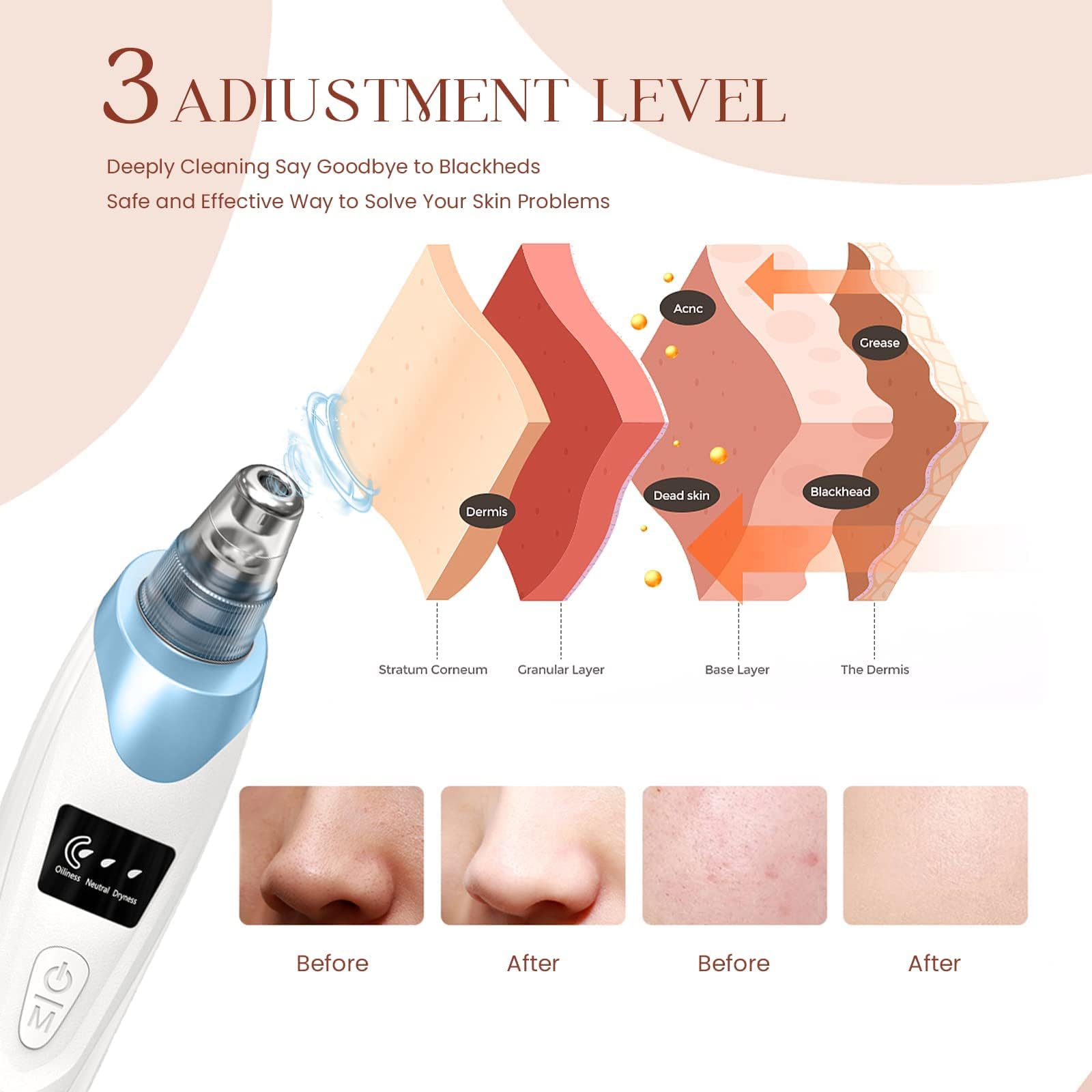 Gackoko 5 suction probes ready for customized skincare