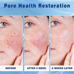 Generic Azelaic Acid Cream with hyaluronic acid on skin for hydration