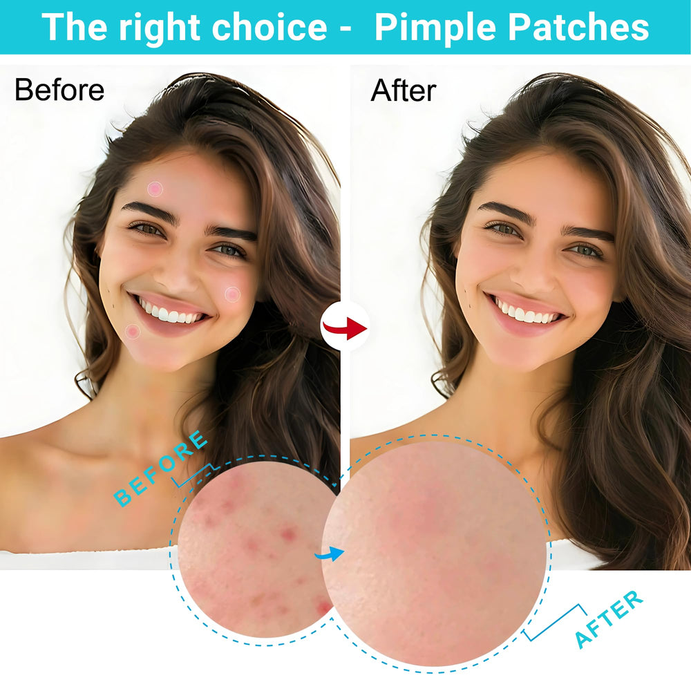 Generic Drug-Free Acne Patch suitable for sensitive skin use.