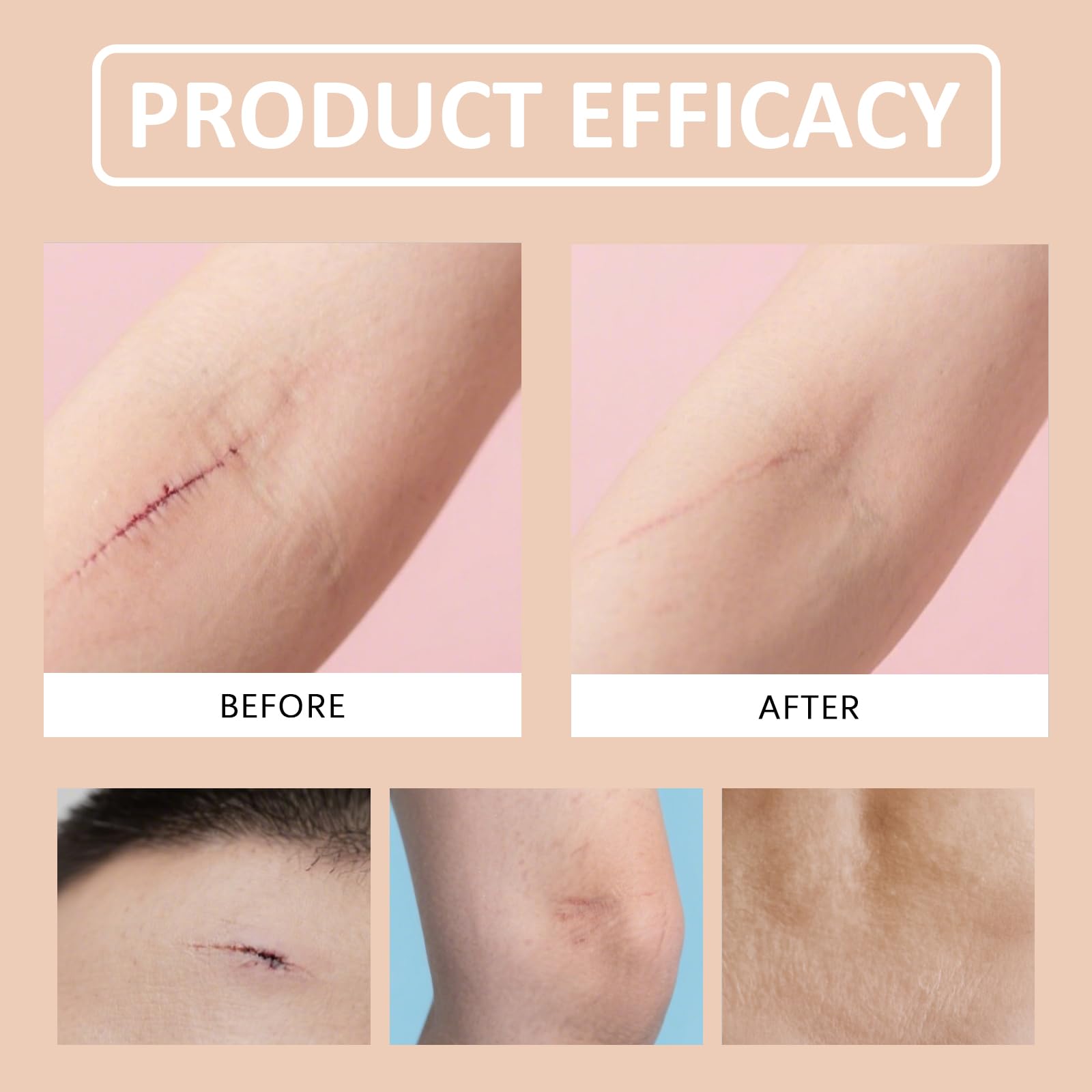 Generic Silicone Scar Stick for burns, gentle moisture barrier.