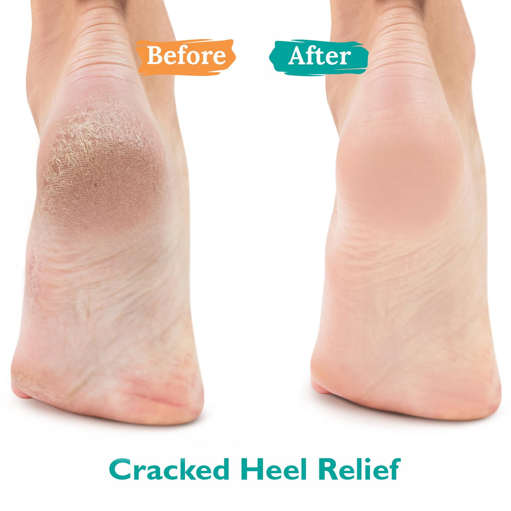 GILDEN TREE Urea Gel 42% being applied to a clean foot.