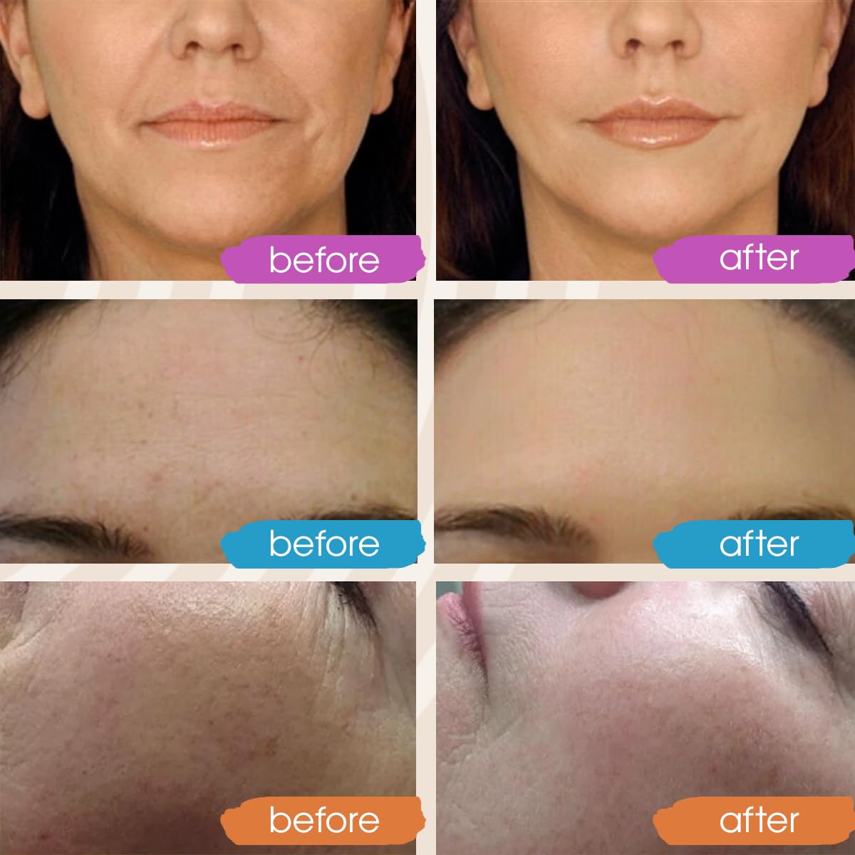 GLEOW Hyaluronic Serum applied on the face for smooth, radiant skin