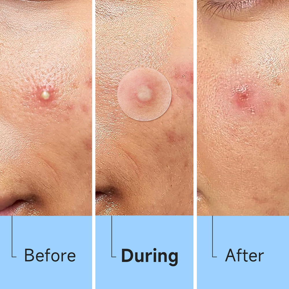 Glowpatch sheet with four sizes fits pimples of all sizes.