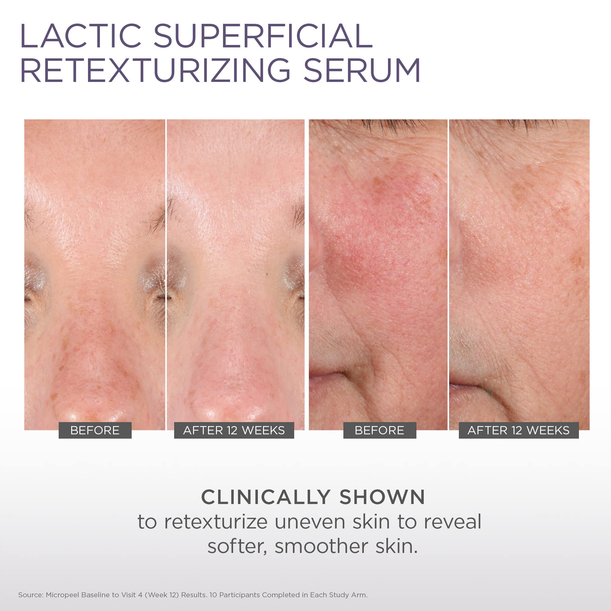 Glytone Micro-Peel being applied to the face to support retexturizing and brightness