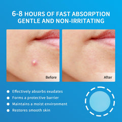 GOESTRIC pimple patches 10mm size used overnight to protect skin while it heals.