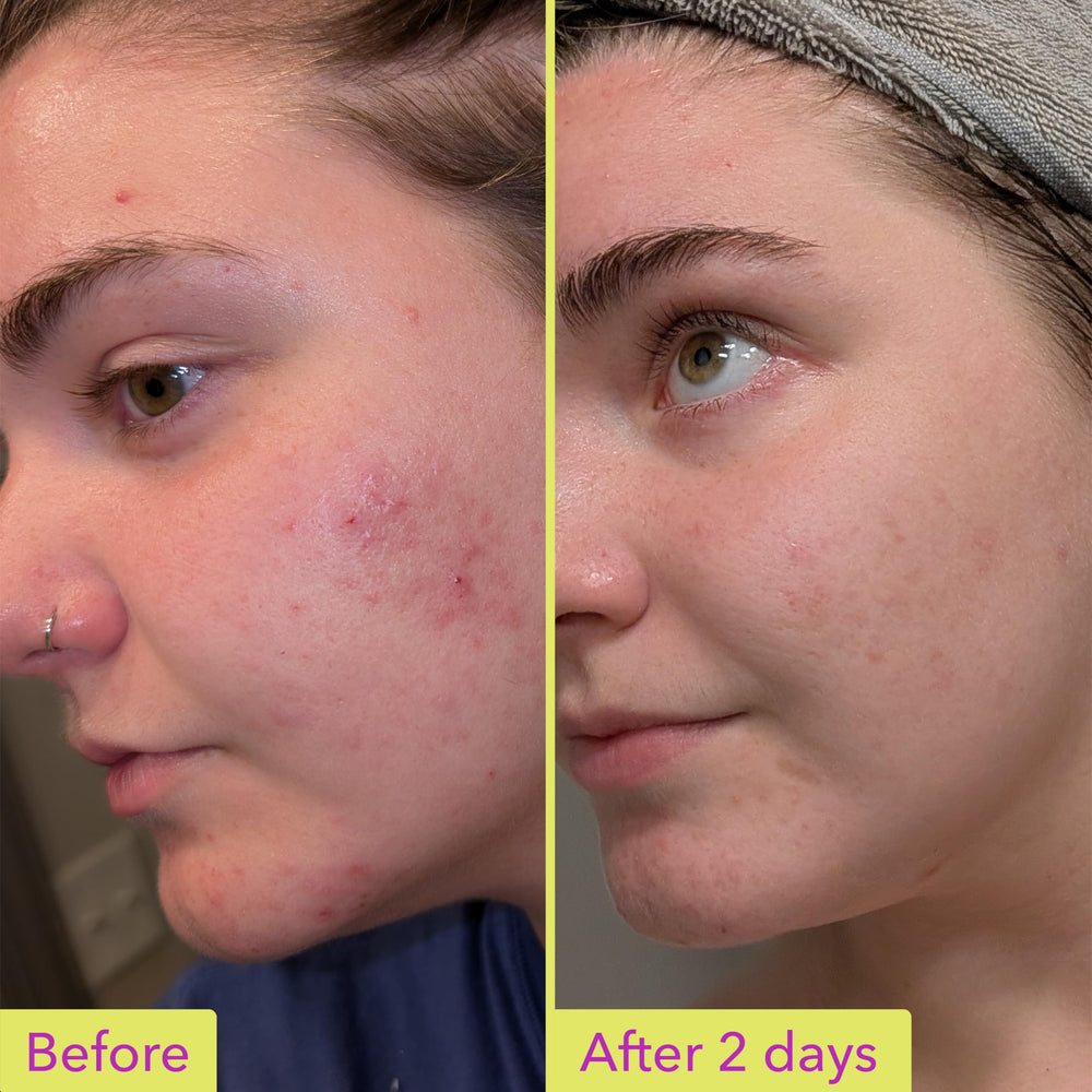Good Molecules 10% Azelaic Acid Treatment texture closeup refined pores over time